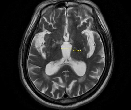 陕西省核工业二一五医院：83岁患者的大脑里医生抓住了一只闯祸的“蜂鸟”！(图2)