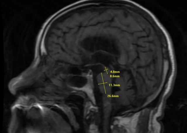 陕西省核工业二一五医院：83岁患者的大脑里医生抓住了一只闯祸的“蜂鸟”！(图3)